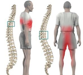 back pain with thoracic osteochondrosis