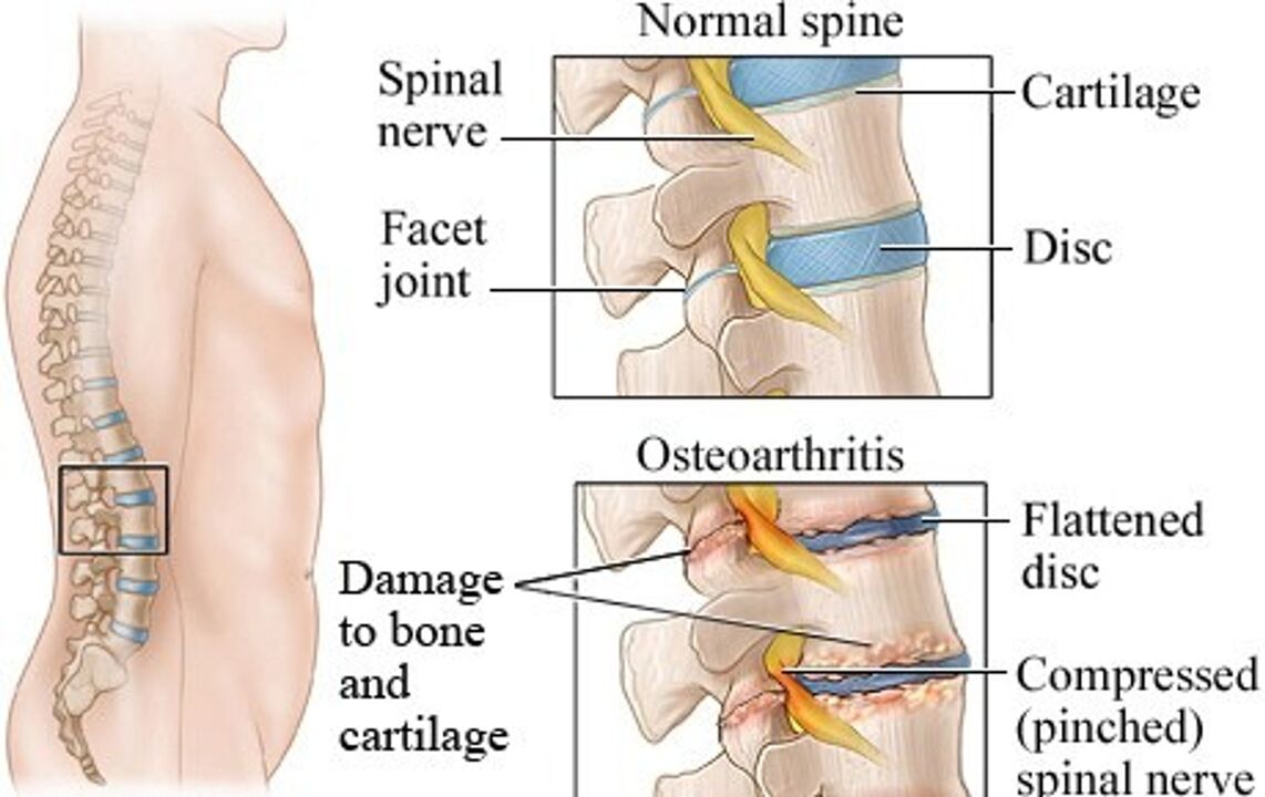 The difference between a healthy disk and a disk with osteochondrosis