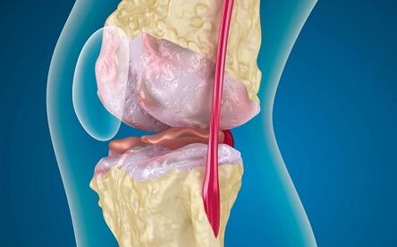 Reasons for developing arthrosis of the knee joint
