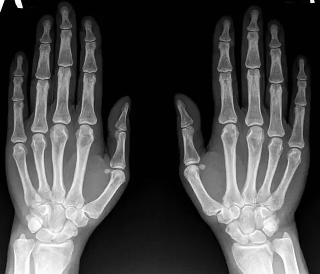 wrist joint arthritis on radiographs prior to Hondroine use